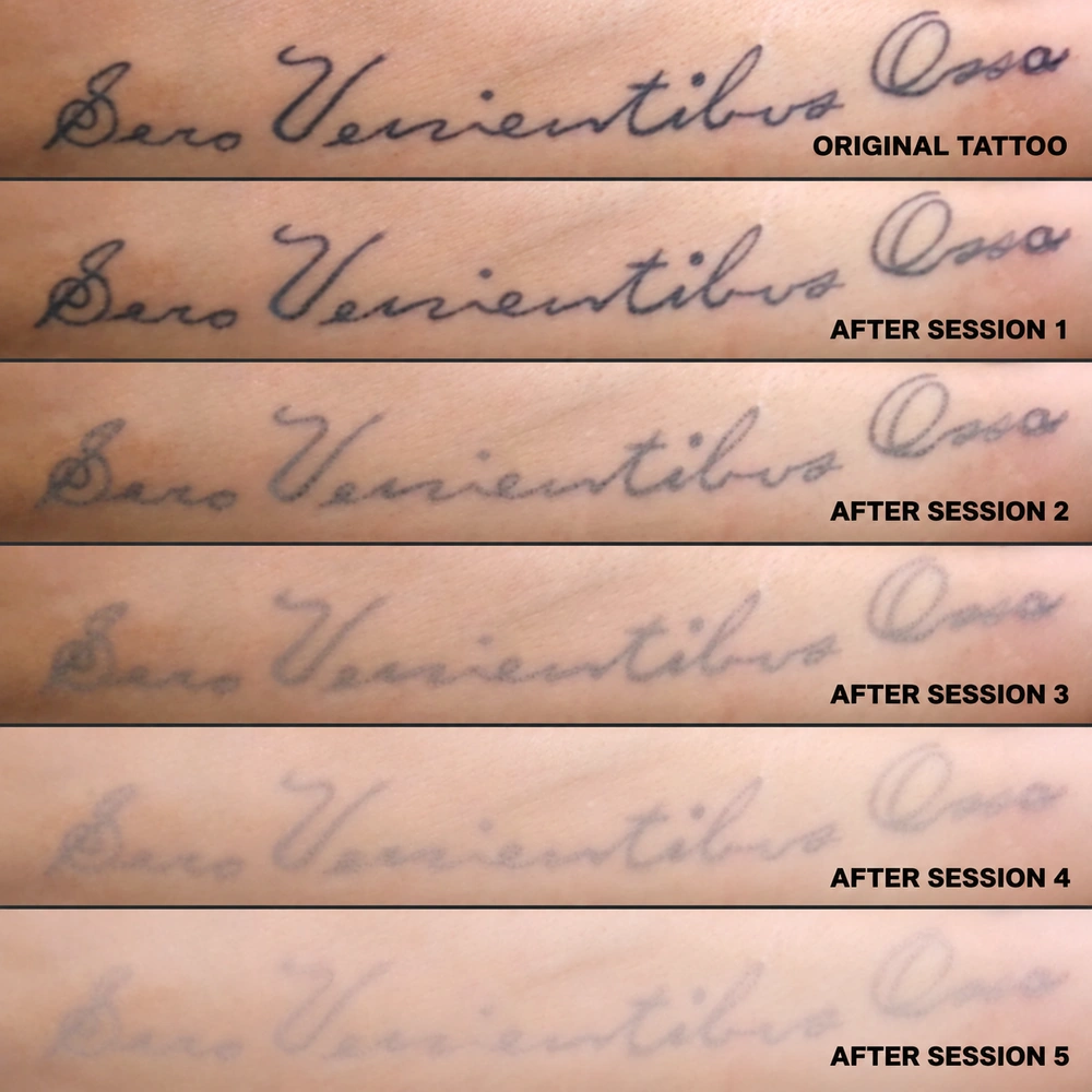 Tattoo removal demonstration for the Skinart online tattoo removal course